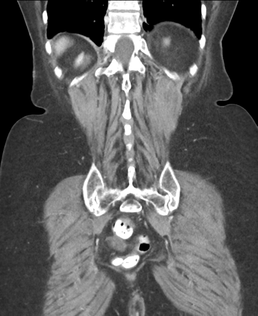 Ampullary adenocarcinoma (Radiopaedia 34013-35237 E 42).png