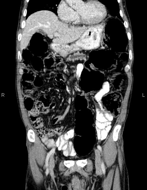 Ampullary adenocarcinoma (Radiopaedia 86093-102032 C 23).jpg