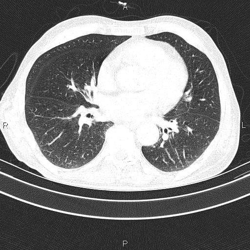Ampullary adenocarcinoma (Radiopaedia 86093-102033 Axial lung window 37).jpg