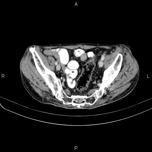 Ampullary adenocarcinoma (Radiopaedia 86093-102033 B 98).jpg
