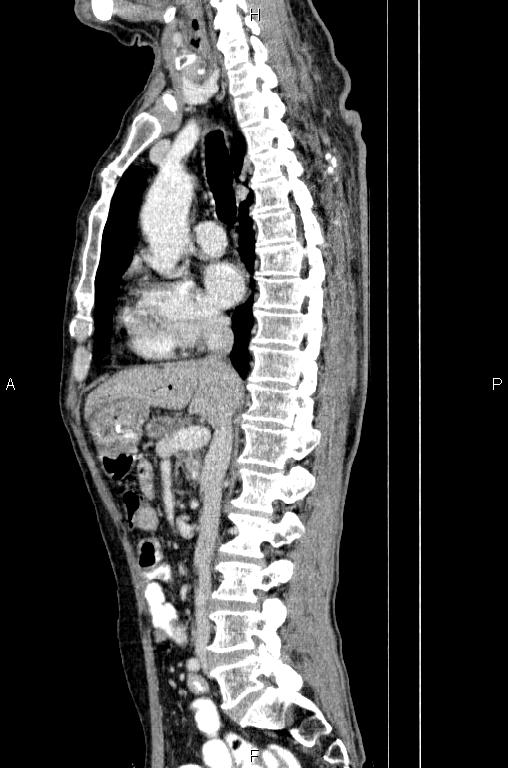 Ampullary adenocarcinoma (Radiopaedia 86093-102033 E 42).jpg