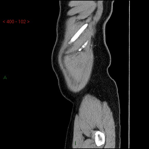 Ampullary carcinoma (Radiopaedia 56396-63056 D 101).jpg