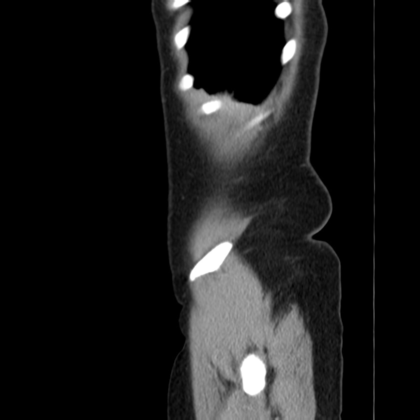 Ampullary tumor (Radiopaedia 22787-22816 D 4).jpg