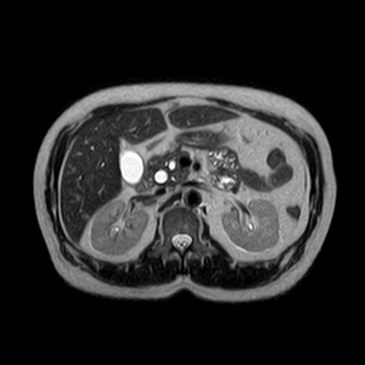 File:Ampullary tumor (Radiopaedia 27294-27479 T2 11).jpg