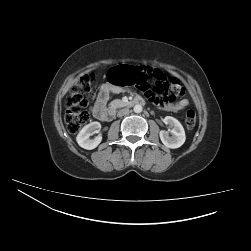 File:Ampullary tumor (Radiopaedia 60333-67998 A 37).jpg