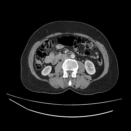 Ampullary tumor (Radiopaedia 60333-67998 A 42).jpg