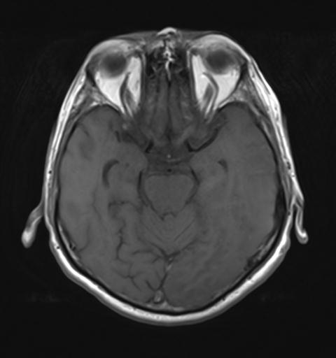 File:Amyloid angiopathy with inflammation (Radiopaedia 30360-31002 Axial T1 12).jpg