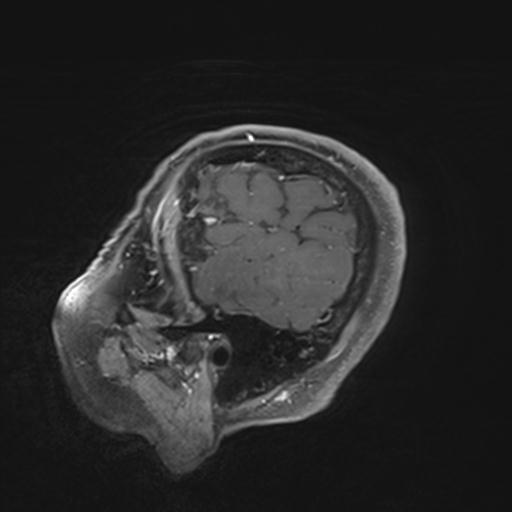 Amyloid angiopathy with inflammation (Radiopaedia 30360-31002 M 158).jpg