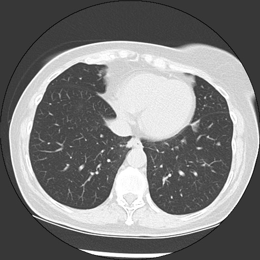 Amyloidosis - bronchial and diffuse nodular pulmonary involvement (Radiopaedia 60156-67744 B 42).jpg
