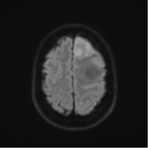Anaplastic astrocytoma (Radiopaedia 57768-64731 Axial DWI 52).png
