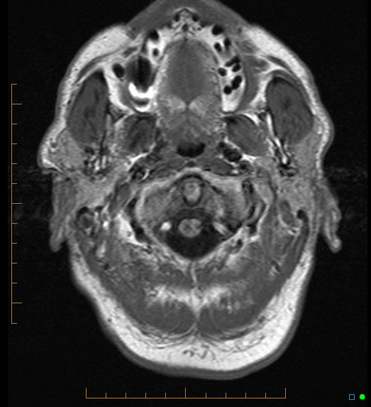 File:Anaplastic astrocytoma (WHO grade III) of the septum pellucidum (Radiopaedia 39365-41633 Axial T1 1).jpg