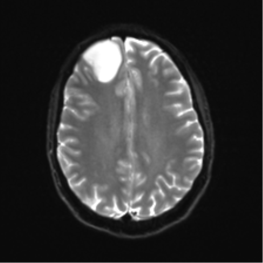 Anaplastic astrocytoma IDH mutant (Radiopaedia 50046-55341 Axial DWI 19).png