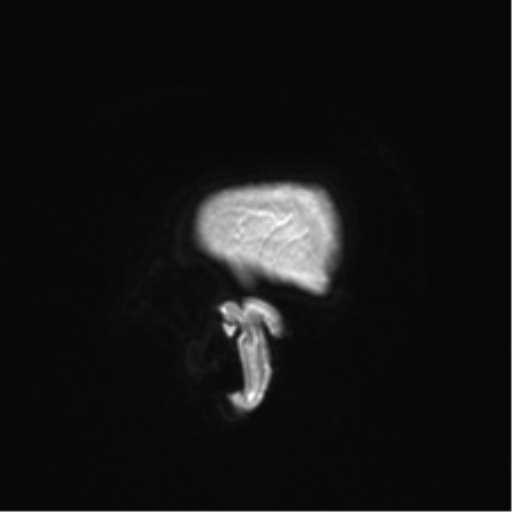 Anaplastic astrocytoma IDH mutant (Radiopaedia 50046-55341 Sagittal T1 C+ 58).png