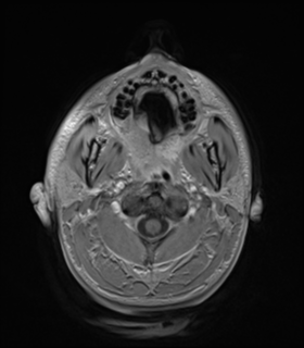Anaplastic astrocytoma IDH wild-type (Radiopaedia 49984-55273 Axial T1 C+ 1).png