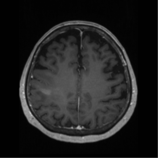 File:Anaplastic astrocytoma IDH wild-type (pseudoprogression) (Radiopaedia 42209-45276 Axial T1 C+ 103).png