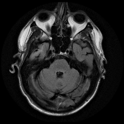 File:Anaplastic meningioma with recurrence (Radiopaedia 34452-35791 Axial FLAIR 6).png