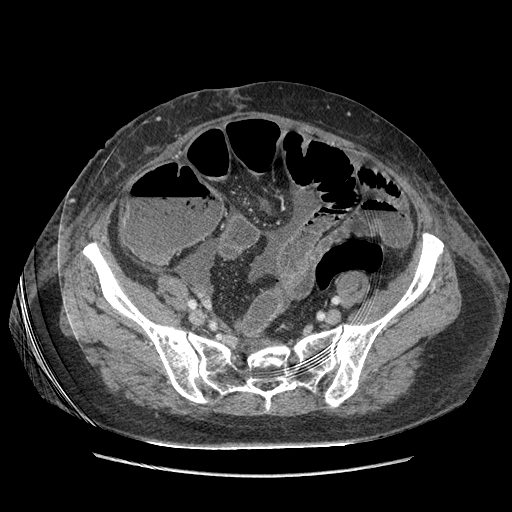 Anastomosis leak at ileostomy closure site (Radiopaedia 82138-96184 B 179).jpg
