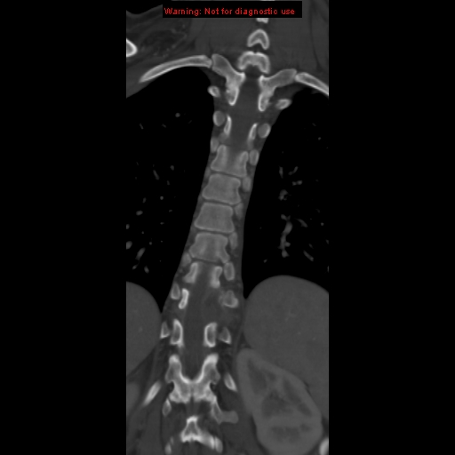 File:Aneurysmal bone cyst (Radiopaedia 9419-10102 Coronal bone window 13).jpg