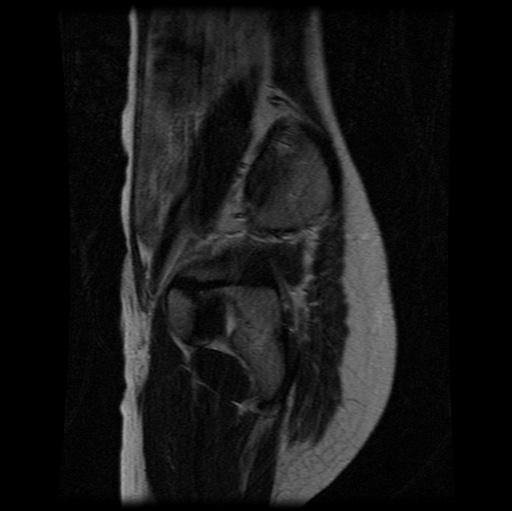 File:Aneurysmal bone cyst - sacrum (Radiopaedia 65190-74196 Sagittal T2 9).jpg