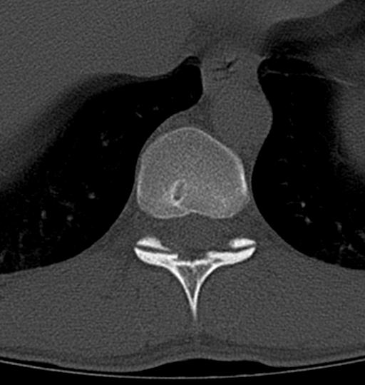 Aneurysmal bone cyst T11 (Radiopaedia 29294-29721 Axial bone window 36).jpg