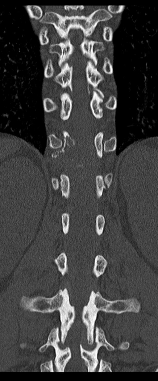 Aneurysmal bone cyst T11 (Radiopaedia 29294-29721 Coronal bone window 40).jpg