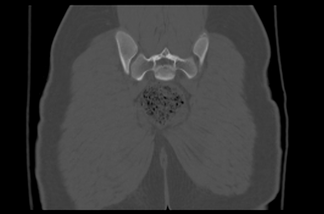 File:Aneurysmal bone cyst of ischium (Radiopaedia 25957-26094 Coronal bone window 40).png
