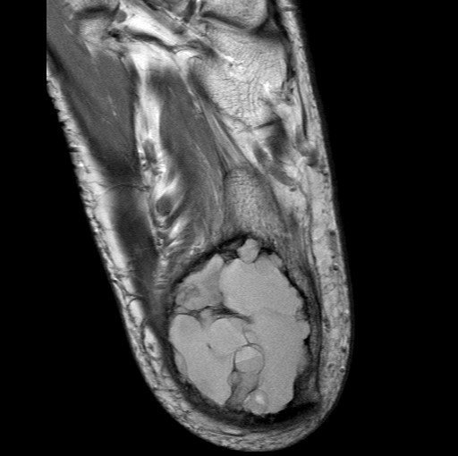 File:Aneurysmal bone cyst of the calcaneus (Radiopaedia 60669-68420 Axial PD 6).jpg
