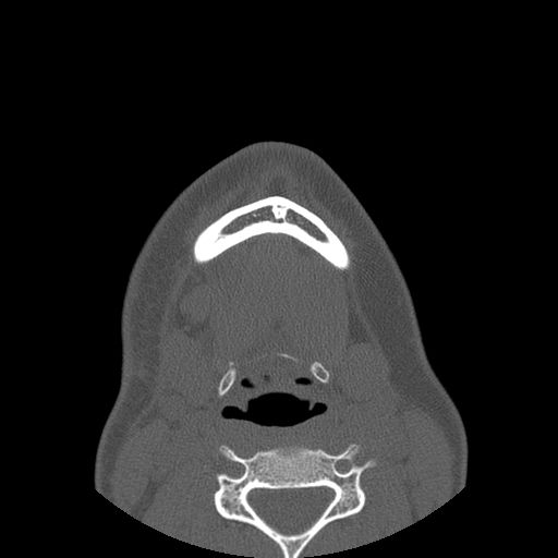 Aneurysmal bone cyst of the mandible (Radiopaedia 43280-46823 Axial bone window 13).jpg