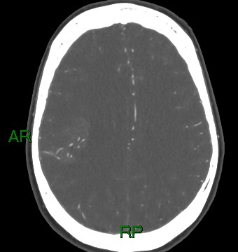 File:Aneurysmal subarachnoid hemorrhage with intra-axial extension (Radiopaedia 84371-99732 A 9).jpg