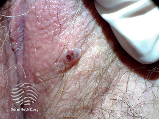 File:Angiokeratoma of Fordyce on vulva (DermNet NZ angiokeratoma-30).jpg