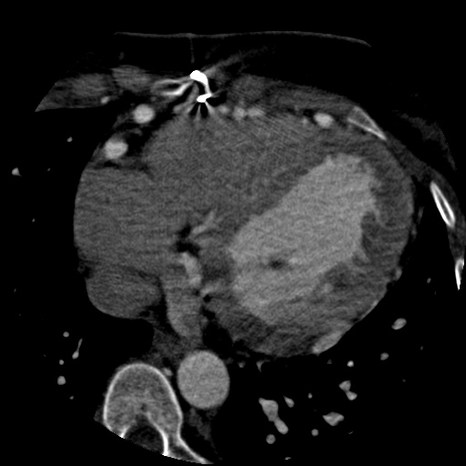 File:Anomalous left coronary artery from the pulmonary artery (ALCAPA) (Radiopaedia 40884-43586 A 59).jpg