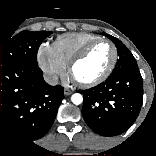 File:Anomalous left coronary artery from the pulmonary artery (ALCAPA) (Radiopaedia 70148-80181 A 258).jpg