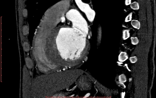 File:Anomalous left coronary artery from the pulmonary artery (ALCAPA) (Radiopaedia 70148-80181 C 154).jpg