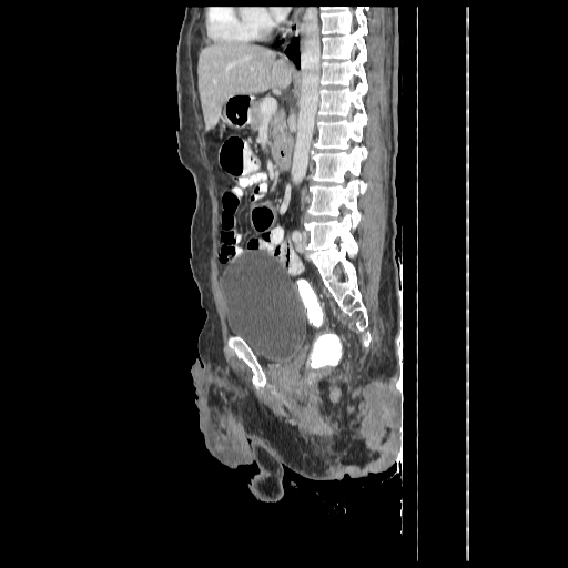 Anorectal carcinoma (Radiopaedia 44413-48064 C 58).jpg