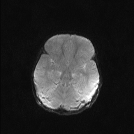 File:Anoxic brain injury (Radiopaedia 79165-92139 Axial DWI 9).jpg