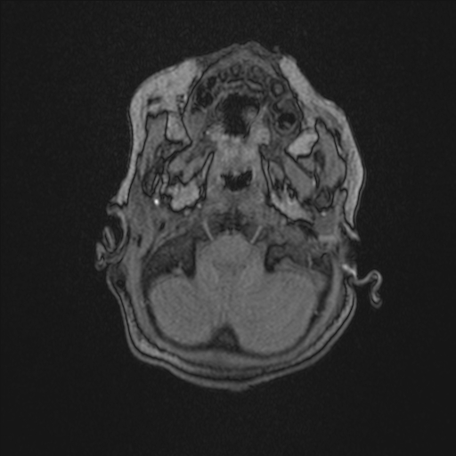 Anoxic brain injury (Radiopaedia 79165-92139 Axial MRA 26).jpg