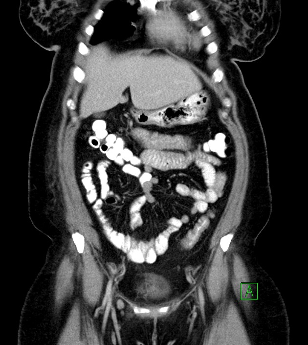 Anterior abdominal wall CSF pseudocyst (CSFoma) (Radiopaedia 79453-92571 B 19).jpg