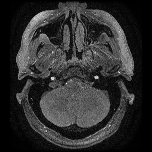 Anterior cerebral artery infarction (Radiopaedia 46794-51323 Axial MRA 4).jpg
