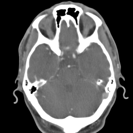File:Anterior cerebral artery territory infarct (Radiopaedia 39327-41581 B 39).png