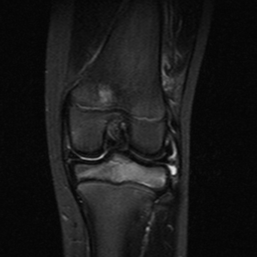 File:Anterior cruciate ligament avulsion fracture (Radiopaedia 24710-24974 Coronal STIR 8).jpg