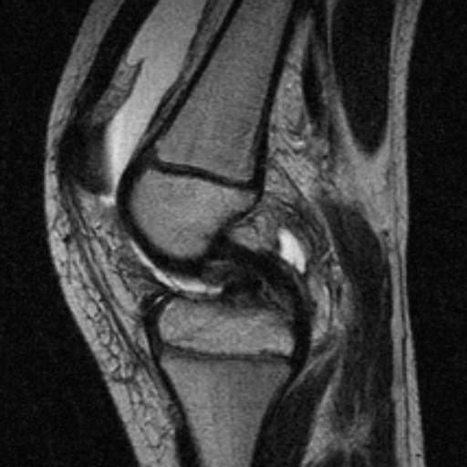 File:Anterior cruciate ligament avulsion fracture (Radiopaedia 24710-24974 Sagittal T2 5).jpg