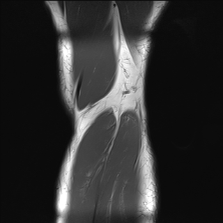 File:Anterior cruciate ligament full thickness tear (Radiopaedia 66268-75467 Coronal T1 22).jpg