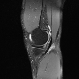 File:Anterior cruciate ligament full thickness tear (Radiopaedia 66268-75467 Sagittal PD fat sat 5).jpg