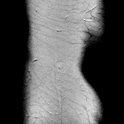 File:Anterior cruciate ligament mucoid degeneration (Radiopaedia 60853-68633 Coronal T2 32).jpg