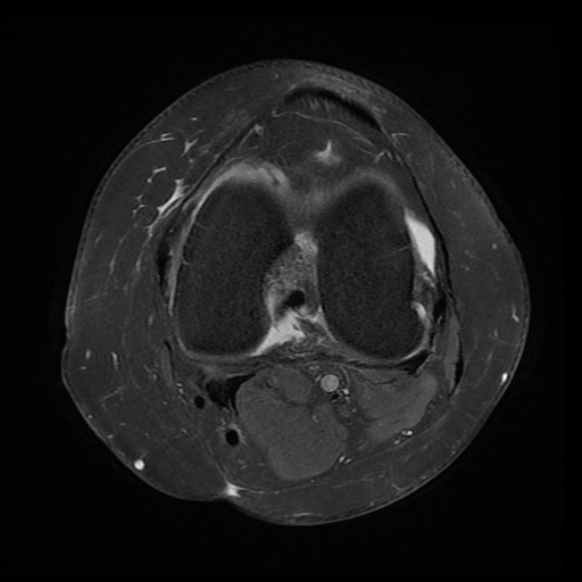 File:Anterior cruciate ligament tear, Wrisberg rip and bucket-handle tear of medial meniscus (Radiopaedia 75872-87266 Axial PD fat sat 13).jpg