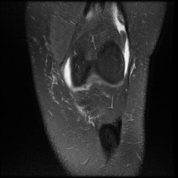 File:Anterior cruciate ligament tear, Wrisberg rip and bucket-handle tear of medial meniscus (Radiopaedia 75872-87266 Coronal PD fat sat 8).jpg