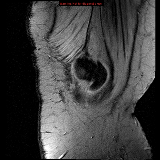 File:Anterior cruciate ligament tear (Radiopaedia 12329-12612 A 20).jpg