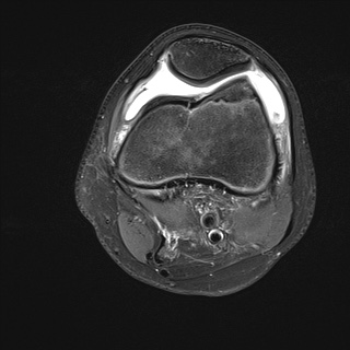 File:Anterior cruciate ligament tear - pediatric (Radiopaedia 62152-70260 Axial PD fat sat 11).jpg
