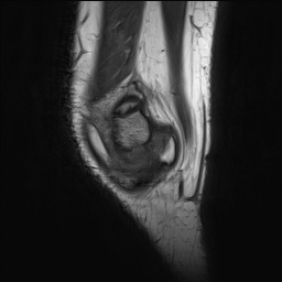 Anterior cruciate ligament tear - pediatric (Radiopaedia 62152-70260 Sagittal PD 24).jpg