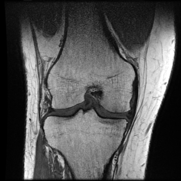 File:Anterior cruciate ligament tear with posteromedial corner injury, bucket-handle meniscal tear and chondral delamination (Radiopaedia 75501-86744 Coronal T1 15).jpg